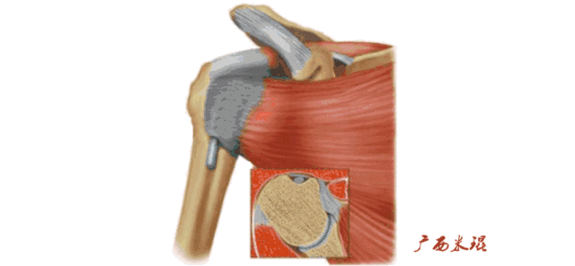 肩袖损伤的MRI诊断技巧