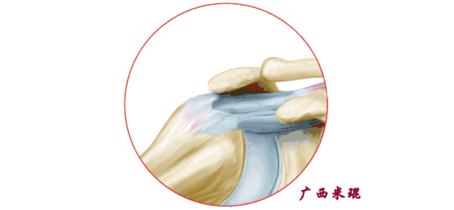 肩袖损伤的MRI诊断技巧