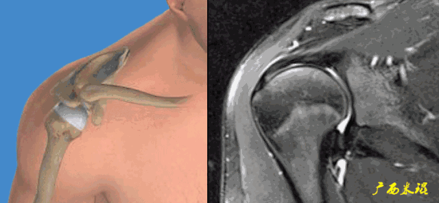 肩袖损伤的MRI诊断技巧