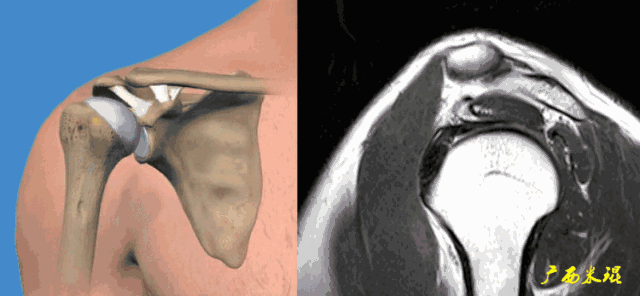 肩袖损伤的MRI诊断技巧