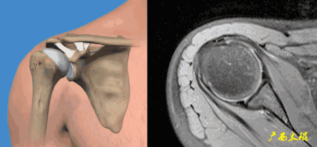 肩袖损伤的MRI诊断技巧