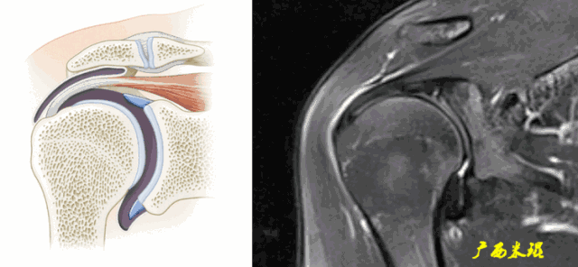 肩袖损伤的MRI诊断技巧