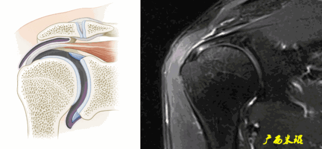 肩袖损伤的MRI诊断技巧