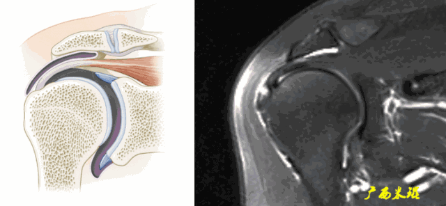 肩袖损伤的MRI诊断技巧