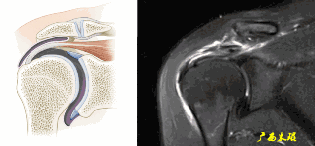 肩袖损伤的MRI诊断技巧