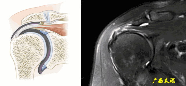 肩袖损伤的MRI诊断技巧