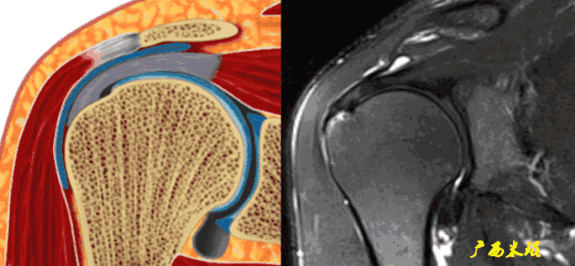 肩袖损伤的MRI诊断技巧