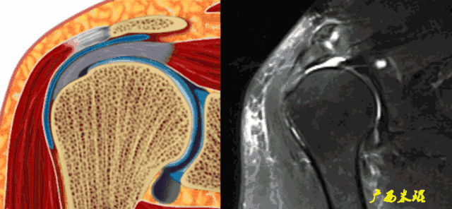 肩袖损伤的MRI诊断技巧