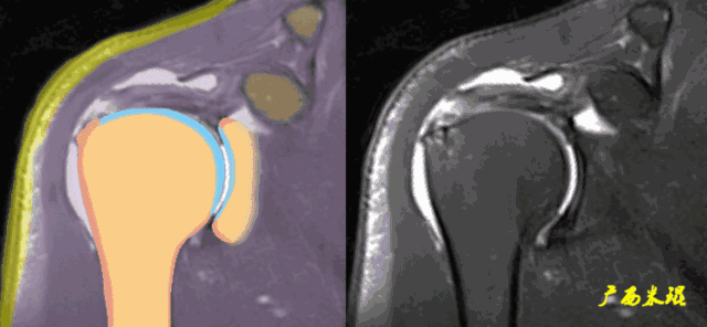 肩袖损伤的MRI诊断技巧