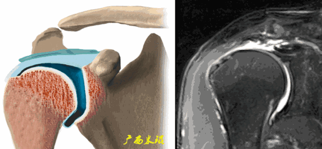 肩袖损伤的MRI诊断技巧