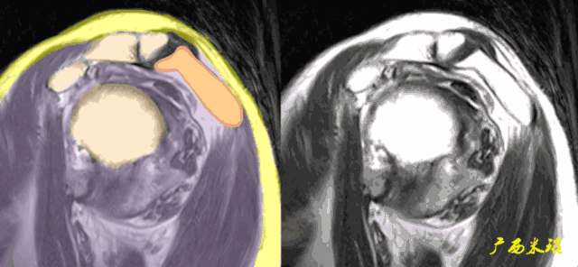肩袖损伤的MRI诊断技巧