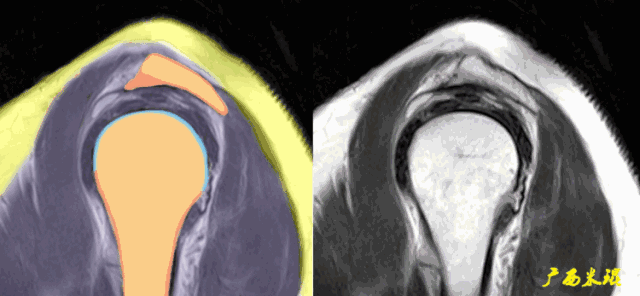 肩袖损伤的MRI诊断技巧