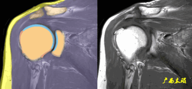 肩袖损伤的MRI诊断技巧