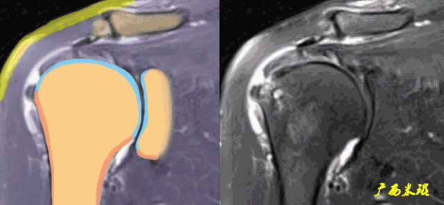 肩袖损伤的MRI诊断技巧