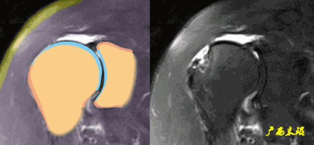 肩袖损伤的MRI诊断技巧