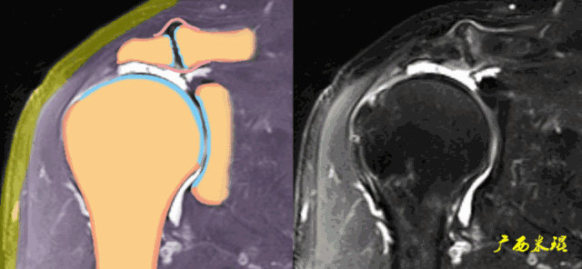 肩袖损伤的MRI诊断技巧