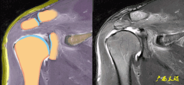 肩袖损伤的MRI诊断技巧