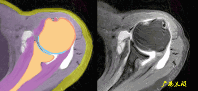 肩袖损伤的MRI诊断技巧