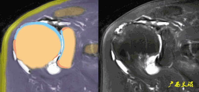肩袖损伤的MRI诊断技巧