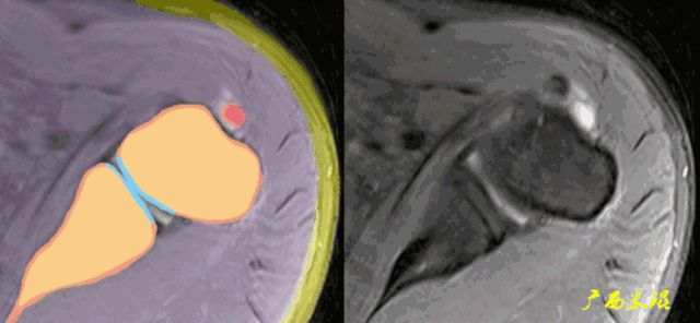 肩袖损伤的MRI诊断技巧
