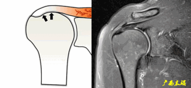 肩袖损伤的MRI诊断技巧