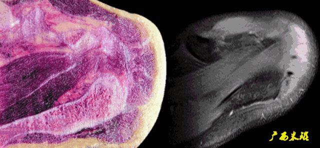 肩袖损伤的MRI诊断技巧