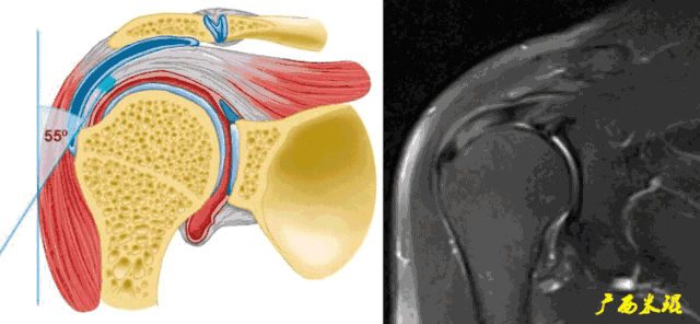 肩袖损伤的MRI诊断技巧