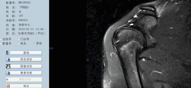 肩袖损伤的MRI诊断技巧