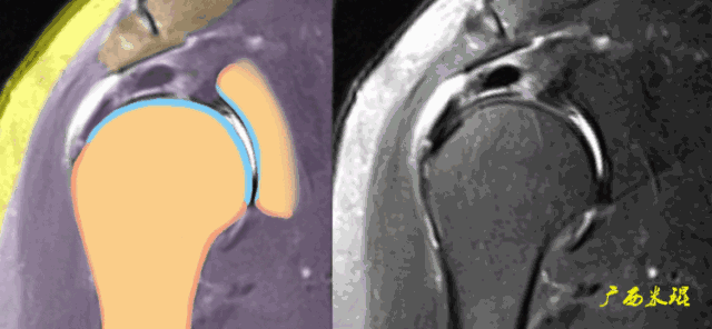 肩袖损伤的MRI诊断技巧