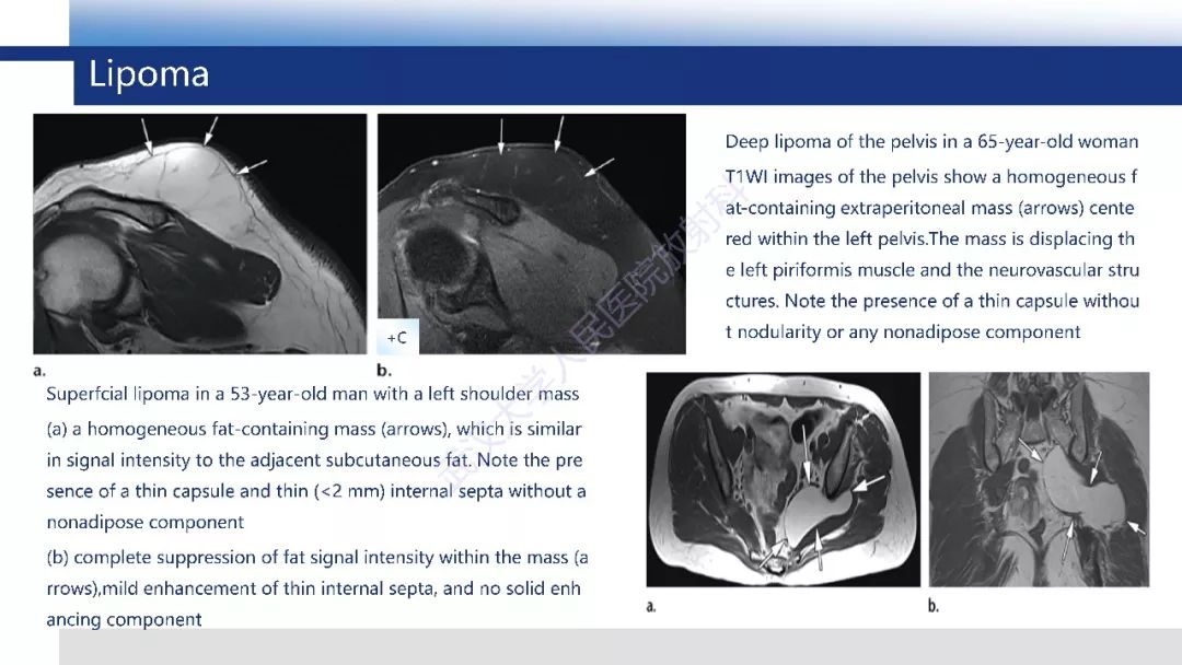 【PPT】含脂肪软组织肿瘤性病变影像诊断