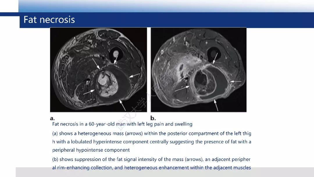 【PPT】含脂肪软组织肿瘤性病变影像诊断