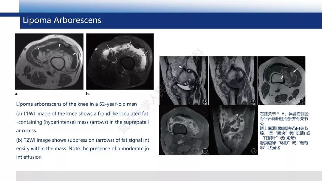 【PPT】含脂肪软组织肿瘤性病变影像诊断