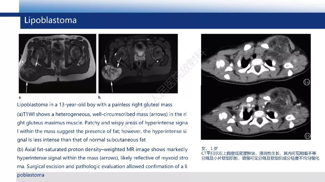 【PPT】含脂肪软组织肿瘤性病变影像诊断