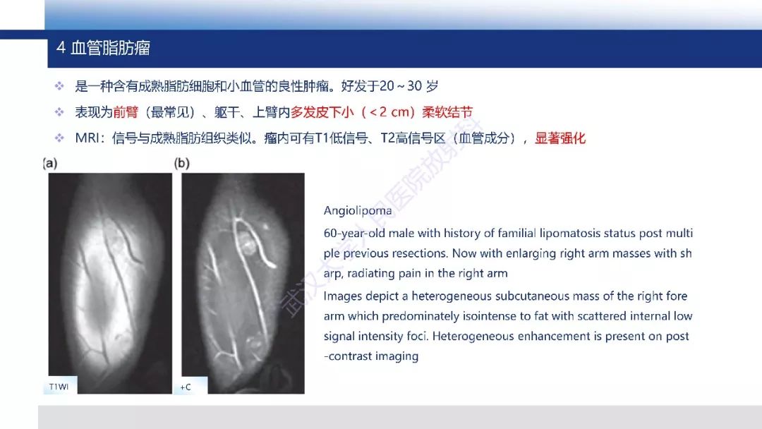 【PPT】含脂肪软组织肿瘤性病变影像诊断