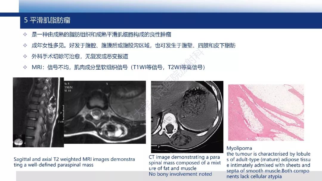 【PPT】含脂肪软组织肿瘤性病变影像诊断