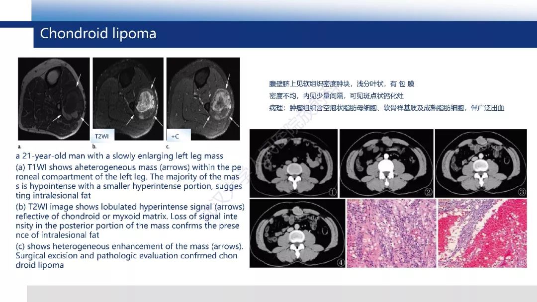 【PPT】含脂肪软组织肿瘤性病变影像诊断