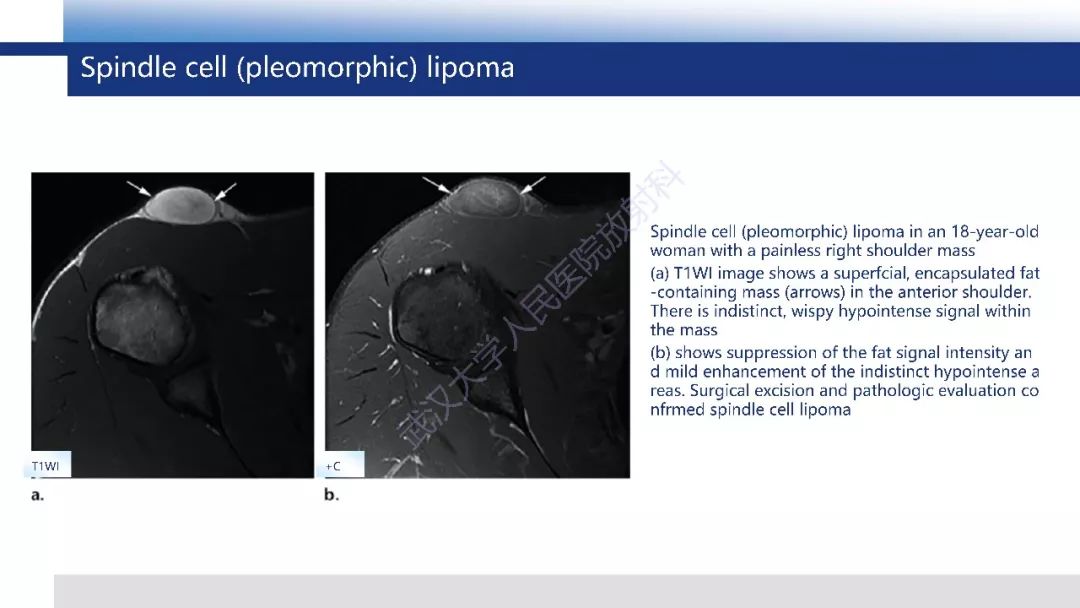 【PPT】含脂肪软组织肿瘤性病变影像诊断