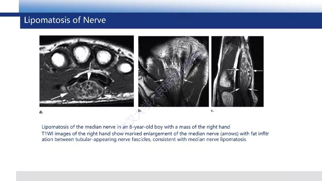 【PPT】含脂肪软组织肿瘤性病变影像诊断