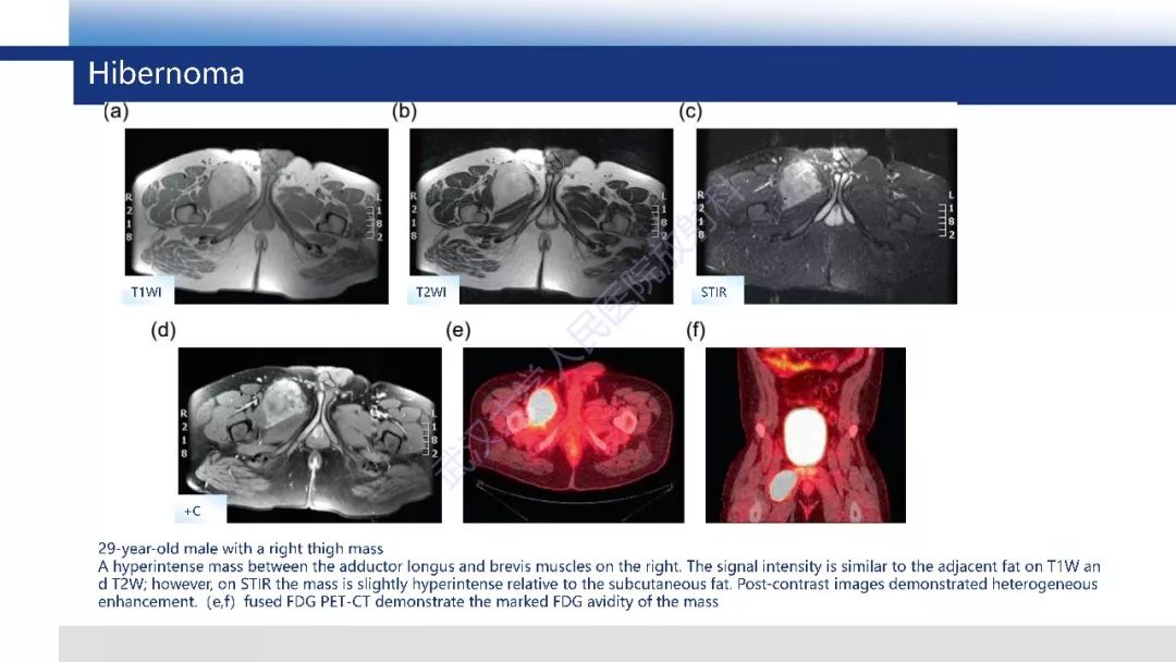 【PPT】含脂肪软组织肿瘤性病变影像诊断