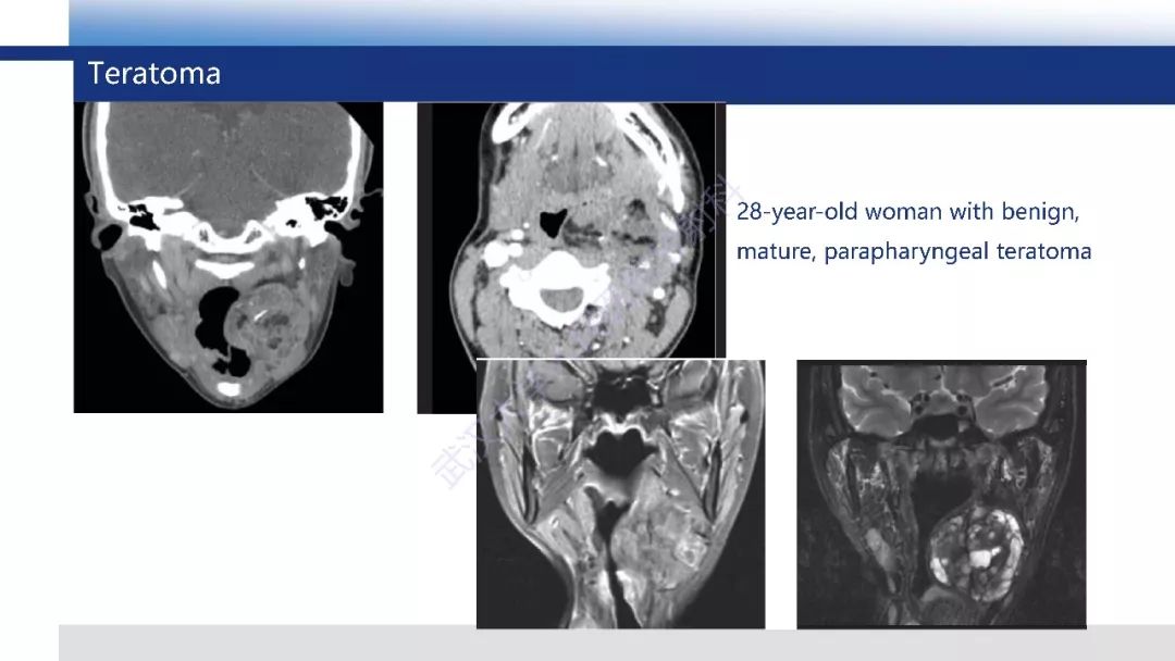 【PPT】含脂肪软组织肿瘤性病变影像诊断