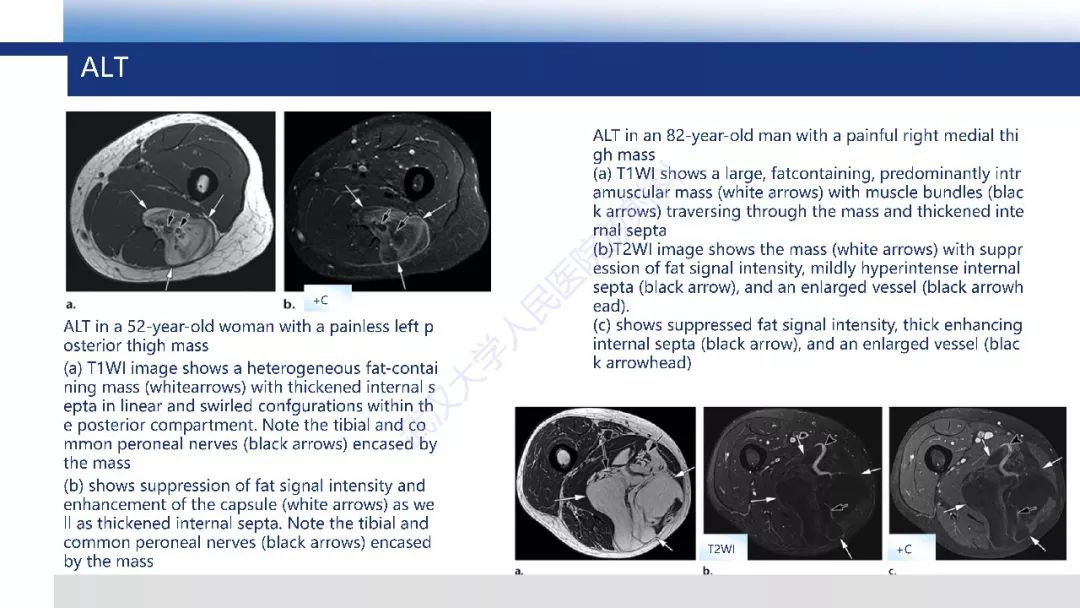 【PPT】含脂肪软组织肿瘤性病变影像诊断