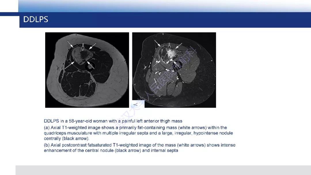 【PPT】含脂肪软组织肿瘤性病变影像诊断