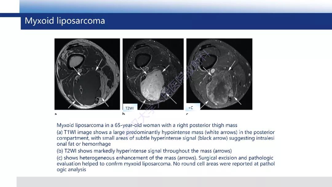 【PPT】含脂肪软组织肿瘤性病变影像诊断