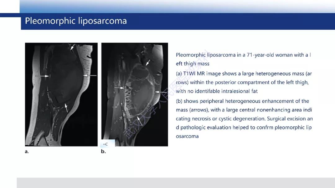 【PPT】含脂肪软组织肿瘤性病变影像诊断