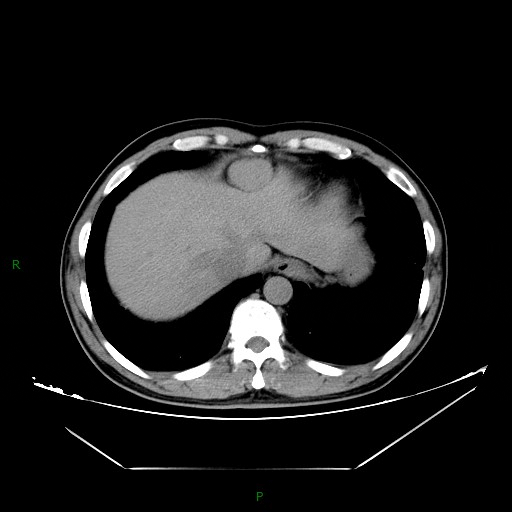 【病例】腹腔异位脾种植1例CT及MR影像-1
