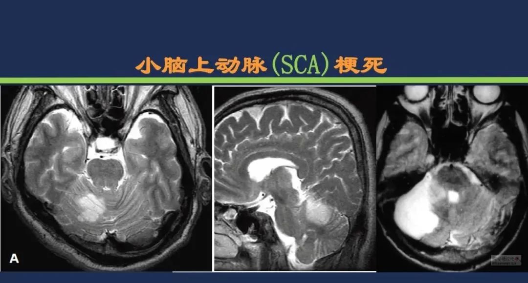 从梗死部位推测责任血管：脑血管解剖-126