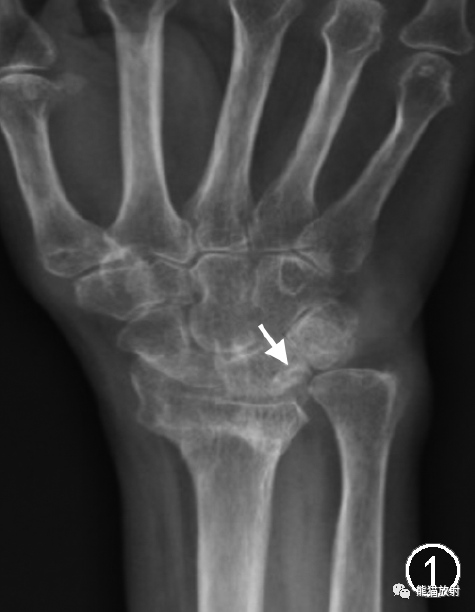 尺骨撞击综合征的临床及影像表现-1