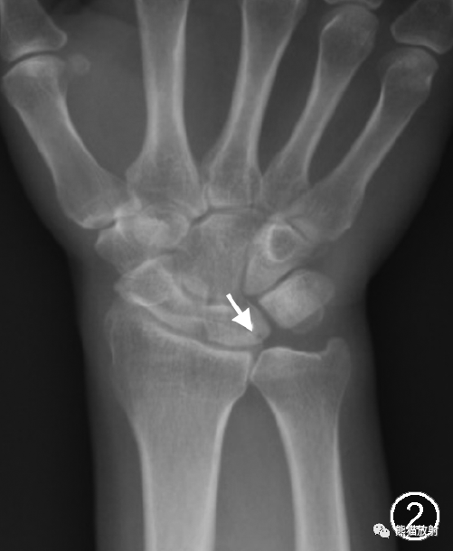 尺骨撞击综合征的临床及影像表现-2