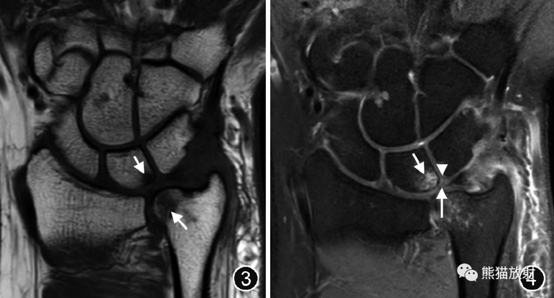 尺骨撞击综合征的临床及影像表现-3