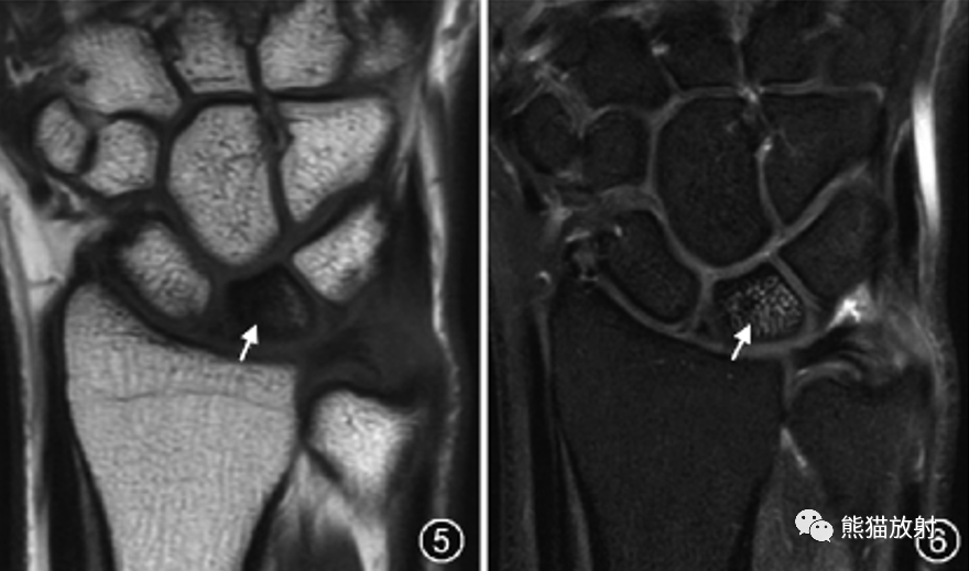 尺骨撞击综合征的临床及影像表现-4